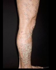 psoriasis, micaceous scale