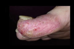 psoriasis on feet with austipz sign