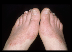 psoriasis on feet