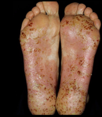 psoriasis on soles