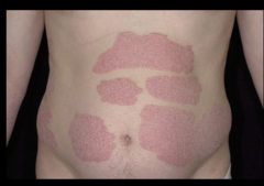 psoriasis, sharply demarcated plaques