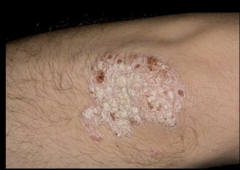 psoriasis with auspitz sign and micaceous scale