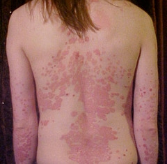 Psoriasis Different Types: Chronic Plaque Psoriasis. Guttate Psoriasis. Pustular Psoriasis--Palmoplantar pustular (Barber's) & Generalized pustular (von Zumbusch). DX: Family /personal history. Clinical examination. Auspitz sign - Punctate bleeding at site of lifted scale. Koebner phenomenon. Biopsy RX: TOPICAL- Dovonex. Vectical. Tazorac. Steroids. Taclonex. Protopic. Emollients/Occlusion. Tar/Anthralin. ORAL- Methotrexate. Cyclosporine (Neoral). Acitretin (Soriatane). Biologic therapy- Amevive (alefacept).Enbrel (etanercept). Remicade. Humira. ULTRAVIOLET THERAPY- UVB with or without tar topicals. UVA with or without Psoralens. ALTERNATIVES- Intralesional injections of Steroids. Petroleum jelly and Saran wrap. Laser. Intense Pulsed Light (IPL). DRUGS THAT EXACERBATE PSORIASIS-Lithium, Beta Blockers, Antimalarials, Systemic steroids. Notes: Affects 1-3% of the population worldwide. Genetically transmitted. Men and women affected equally. Can be associated with generalized Arthritis. Differential diagnosis: Fungal Infections. Pityriasis Rosea. Cutaneous Lupus. Erythematosus. Drug Eruptions Psoriasis Different Types: Chronic Plaque Psoriasis. Guttate Psoriasis. Pustular Psoriasis--Palmoplantar pustular (Barber's) & Generalized pustular (von Zumbusch). DX: Family /personal history. Clinical examination. Auspitz sign - Punctate bleeding at site of lifted scale. Koebner phenomenon. Biopsy RX: TOPICAL- Dovonex. Vectical. Tazorac. Steroids. Taclonex. Protopic. Emollients/Occlusion. Tar/Anthralin. ORAL- Methotrexate. Cyclosporine (Neoral). Acitretin (Soriatane). Biologic therapy- Amevive (alefacept).Enbrel (etanercept). Remicade. Humira. ULTRAVIOLET THERAPY- UVB with or without tar topicals. UVA with or without Psoralens. ALTERNATIVES- Intralesional injections of Steroids. Petroleum jelly and Saran wrap. Laser. Intense Pulsed Light (IPL). DRUGS THAT EXACERBATE PSORIASIS-Lithium, Beta Blockers, Antimalarials, Systemic steroids. Notes: Affects 1-3% of the population worldwide. Genetically transmitted. Men and women affected equally. Can be associated with generalized Arthritis. Differential diagnosis: Fungal Infections. Pityriasis Rosea. Cutaneous Lupus. Erythematosus. Drug Eruptions