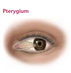 pterygium