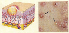 Pustules