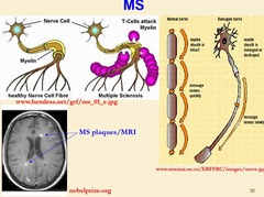 Question: what is the classification of multiple sclerosis (MS)?