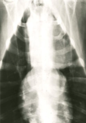radiograph of mediastinal lymphoma