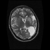 Rassmussen's Syndrome (Etiology, clinical presentation, Tx)