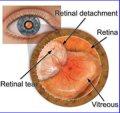 Retinal detachment