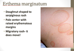 rheumatic fever