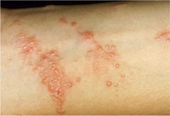 Rhus Contact Dermatitis (Poison Ivy)