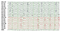 Rolandic epilepsy EEG