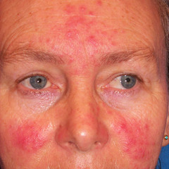 Rosacea  Keys: lack of comedones, worse with alcohol, telangiectasias