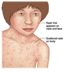Rubella (German measles or three-day measles)