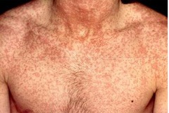 Rubella - German Measles