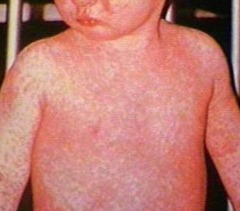 Rubeola (Measles)