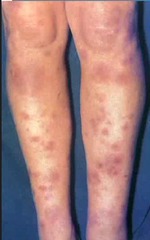 *Sarcoidosis* Also hypercalcemia 2/2 increased macrophages making vitamin D  Dx: biopsy - non-caseating granuloma Txt: steroids