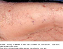Sarcoptes scabiei—lesions.   Note three arrows that point to linear track-like lesions on the hand.   (Reproduced with permission from Wolff K, Johnson R. Fitzpatrick's Color Atlas & Synopsis of Clinical Dermatology. 6th ed.