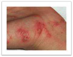 scabies characteristics