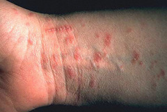Scabies  May describe mite burrow  Intense itching, ESP axillary and interdigital webs