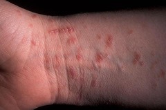Scabies Txt: 5% Permetrin for whole household