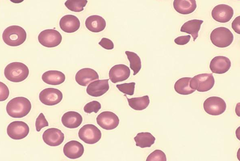 Schistocytes! DIC  Causes: Sepsis, rhabdo, adenocarcinoma, heatstroke, pancreatitis, snake bites, OB stuff, Tx of M3 AML (Auer rods) Txt: FFP, platelet transfusion, correct underlying d/o