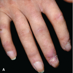 Scleroderma (lSSc): acrosclerosis   (A) Hands and fingers are edematous (nonpitting); skin is without skin folds and bound down. Distal fingers are tapered (Madonna fingers)   Fitzpatrick Figure 14-45
