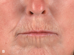 Scleroderma (lSSc): acrosclerosis   (B) Thinning of lips—microstomia (which would show better when patient attempts to open her mouth), radial perioral furrowing. Beaklike sharp nose.  Fitzpatrick Figure 14-46