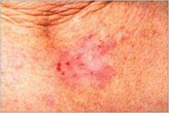 Sclerosing (Scarring) Basal Cell Carcinoma (Least common and most aggressive.)