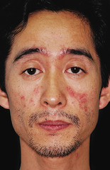 Seborrheic Dermatitis (dandruff)