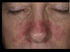 seborrheic dermatitis (dont confuse with lupus)