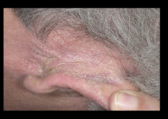 seborrheic dermatitis of ears
