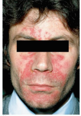 seborrheic dermatitis of nasolabial groove