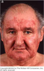 seborrheic dermatitis