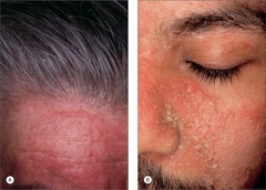 Seborrheic dermatitis (Buildup of YEAST on the skin)