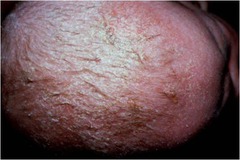 Seborrheic Dermatitis (Favors scalp, ears, face, central chest, and intertrigious areas; associated with with Malassezia Furfur [pitrysorom ovale]; can be severe and refractory in HIV)