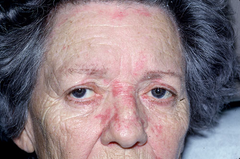 Seborrheic Dermatitis  Fine or greasy yellow-red scaling macules and papules  Location-forehead, chest, scalp, eyebrows, bodyfolds  (Marlin D&E Lecture PP31;34)