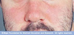 Seborrheic Dermatitis  Subacute or chronic inflammation of areas with numerous sebaceous glands  (Marlin D&E Lecture PP31;34)