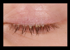 seborrheic dermtitis of eyelids