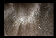 seborrheic dermtitis of scalp