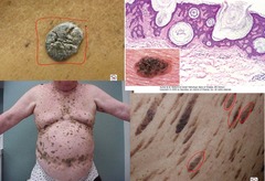 Seborrheic keratosis (SK)