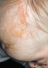 Seborrhoeic dermatitis