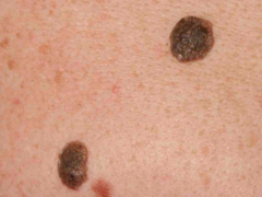 Seborrhoeic keratoses