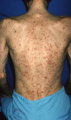Severe chickenpox