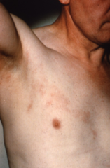 Shingles - early erythema