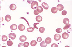 Sickle cell blood smear