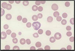 Spherocyte