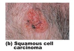 Squamous cell cancer (SCC):