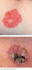 Squamous cell carcinoma in situ:   Bowen disease   (A) A large, sharply demarcated, scaly, and erythematous plaque simulating a psoriatic lesion.   (B) A similar psoriasiform plaque with a mix of scales, hyperkeratosis, and hemorrhagic crusts on the surface.  Fitzpatrick 11-4