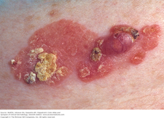 Squamous cell carcinoma in situ (SCCIS): Bowen disease and invasive SCC:   1. Topical Chemotherapy 5-Fluorouracil,  2. Cryosurgery  3. Photodynamic Therapy  4. Surgical Excision Including Mohs Micrographic Surgery  Fitzpatrick 11-5